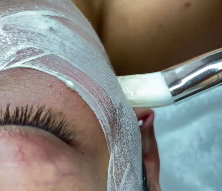 Kosmetische Aknebehandlung bei Lune Beauty in Worms